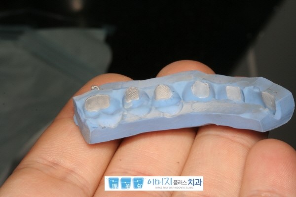 indirect bonding - Putty method [서면교정치과] : 네이버 블로그