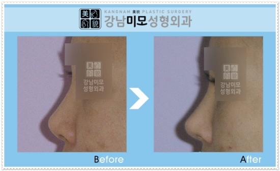 들창코 스트레스는 강남미모성형외과 코수술로~ : 네이버 블로그