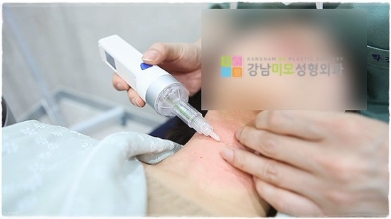 강남미모성형외과의 목주름시술과 목주름제거술 알아보기! : 네이버 블로그