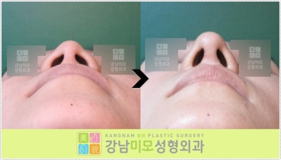 낮은코는 이제 강남미모성형외과에서 코성형하자~ : 네이버 블로그