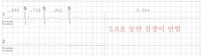 부정맥은 아주 위험한가요? : 네이버 블로그