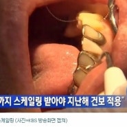 6월까지 스케일링 보험적용 종료 (2013년분),, 어서 서둘러요