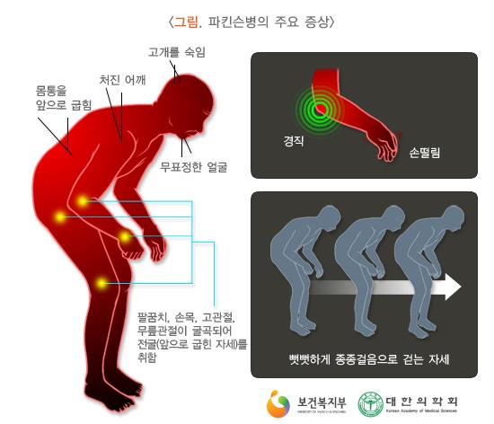세모난 한의원의 파킨슨 환자 49회 치료 후 경과 보고 : 네이버 블로그