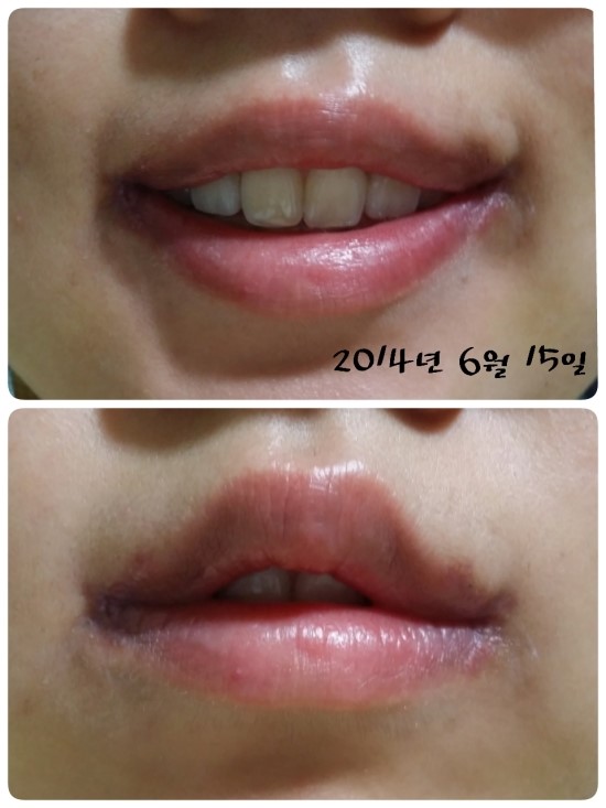 [입꼬리수술+외측올림+진피이식]18일차~25일차 후기! : 네이버 블로그