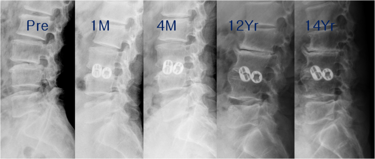 Time, aging muscles win always! ASD after lateral ALIF? DLIF? XLIF ...