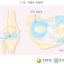 무릎 반월상연골 파열(손상)