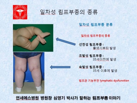 [림프부종] 일차성 림프부종의 종류 : 네이버 블로그