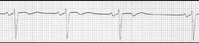 supraventricular arrhythmia-premature atrial complex(PAC) : 네이버 블로그