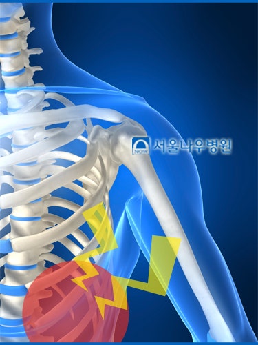 가슴이 찌릿찌릿 왼쪽 옆구리통증 원인 ‘늑간신경통’ : 네이버 블로그