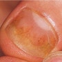 조갑박리증,Onycholysis,노랗게 변한 손톱,희게 변한 손톱,외상에 의한 조갑박리.벌어진 손톱,벌어진 발톱