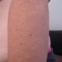 Bier Spots,비어 반점,비어점,Marshall–White syndrome,Angiospastic Macules,팔에 생긴 흰색 반점