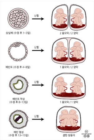 일란성 단일양막 쌍둥이 : 네이버 블로그 일란성 단일양막 쌍둥이 : 네이버 블로그