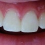 [레진치료] 벌어진 치아, 치과 레진치료로 해결하세요