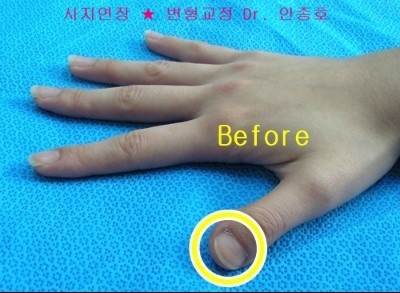 엄지 우렁손톱/단지증 교정술 : 네이버 블로그