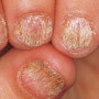 Onychorrhexis,조갑종렬증,Trachyonychia,손발톱거침증,세로로 갈라지는 손톱,조갑거침증,조갑조면증,20-nail dystrophy