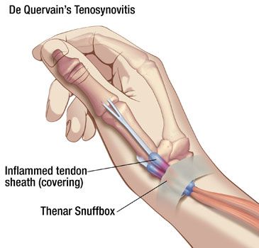 [의학 칼럼] 드퀘르벵 병(DeQuervain’s tenosynovitis), 손목건초염, 요골경돌기힘줄윤활막염 - 손목 안쪽이 아파요 : 네이버 블로그