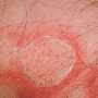 Erythema annulare centrifugum,중심 원심성 윤상 홍반,원심성 고리 홍반,원심성환상홍반,몸에 생긴 붉은 고리 반점,몸에 생긴 고리모양 띠