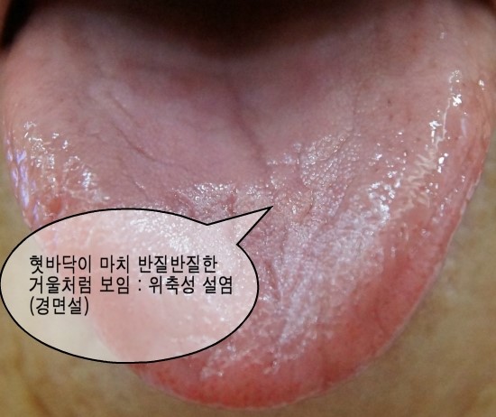 위축성 설염 (경면설) / 구강건조증 - 고령자의 혀 통증 : 네이버 블로그