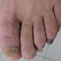 Acrokeratosis Verruciformis,사마귀양 선단각화증,발가락 위에 생기는 올록볼록한게 생겨요