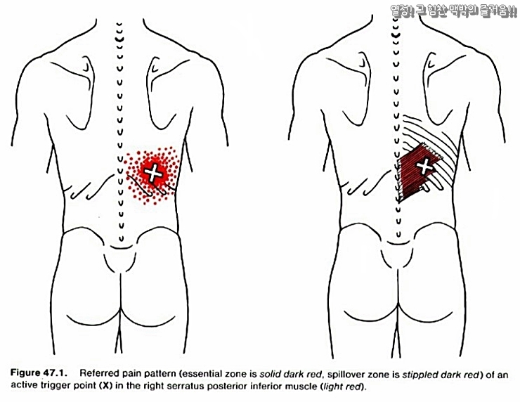 trigger-point