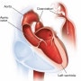 [간호이야기]대동맥축착증(Coarctation of Aorta,CoA)