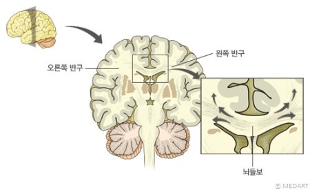 corpus callosum 뇌들보 : 네이버 블로그
