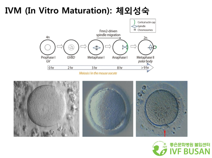 IVM (In vitro maturation): 미성숙난자의 체외성숙을 통해 임신성공률을 극대화시키는 시험관아기 방법 : 네이버 블로그