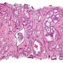 <해외 기사> 마침내 비타민D와 전립선암의 잃어버린 고리를 찾아내다 (Finally: A missing link between vitamin D and prostate cancer)