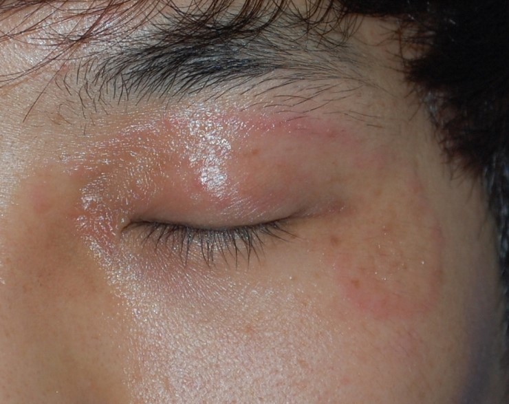 얼굴백선증(Tinea faciale) : 네이버 블로그