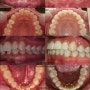 사각턱 치아교정(과개교합 교정) 전후사진