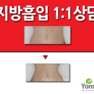 강북지방흡입 효과대박 노원연세성형외과