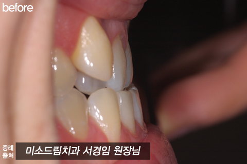 덧니교정 전후, 비용은! : 네이버 블로그