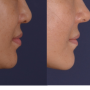 코끝수술에서 코밑 돌출이 중요하다.(The importance of the subnasal point protrusion in the nose tip surgery)