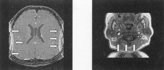 Mri Aliasing Artifact 네이버 블로그