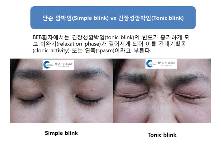  benign essential blepharospasm beb 