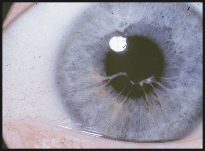 동공막잔류 동공막잔존 동공막존속 persistent pupillary membrane : 네이버 블로그
