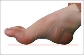 샤르코 마리 투스 질환Charcot-marie-tooth foot의 효과적 대응 : 네이버 블로그