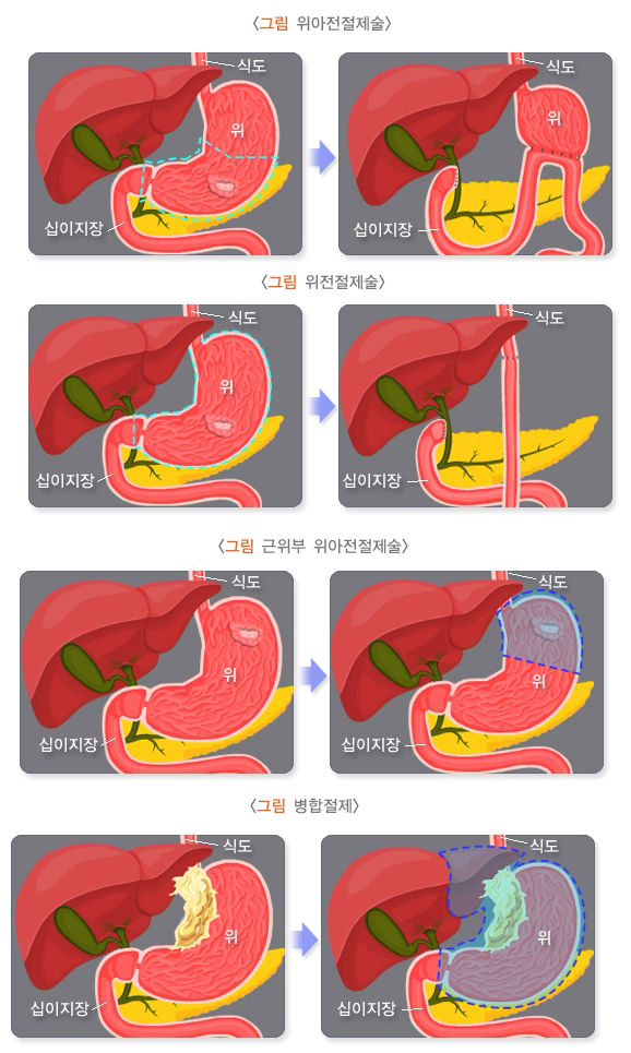 위암 : 네이버 블로그