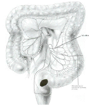 (LAR) Lower anterior resection : 네이버 블로그