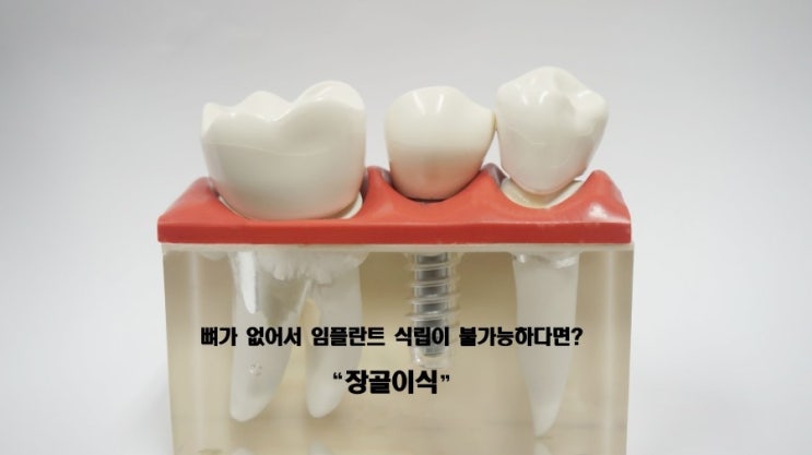 뼈가 없어 임플란트 식립이 불가능하다면 장골이식으로 : 네이버 블로그