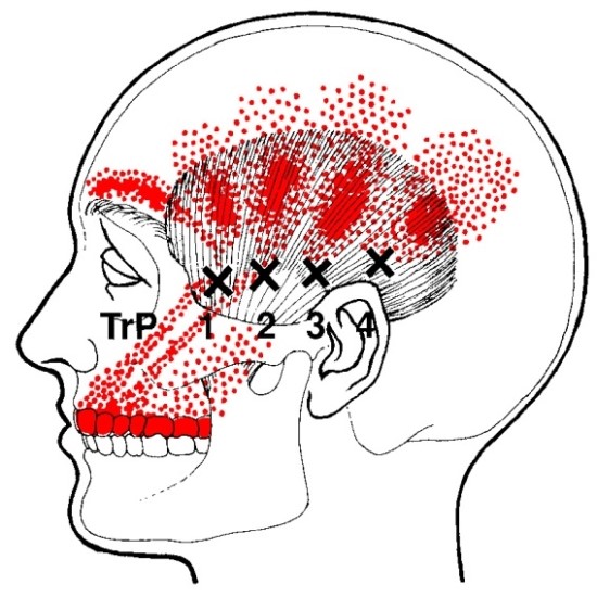 Tension Headache Common Migraine 네이버 블로그