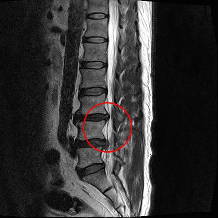 The Forward Displacement Of A Vertebra Spondylolisthesis 脊椎骨向前推进导致腰椎滑脱 네이버블로그