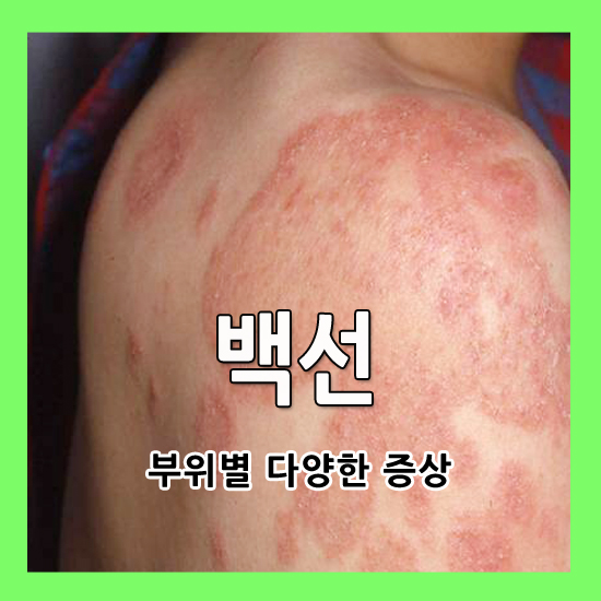 부위별 백선 증상, 이렇게 다양할수가? : 네이버 블로그