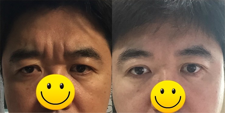 미간주름 보톡스와 안면 피드백이론, 정서적 전염 : 네이버 블로그