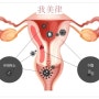 생리불순, 생리통, 질염증상 등 자궁질환 한방치료는 자궁디톡스로 해결!