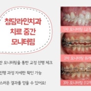 청담라인치과 치아교정사례