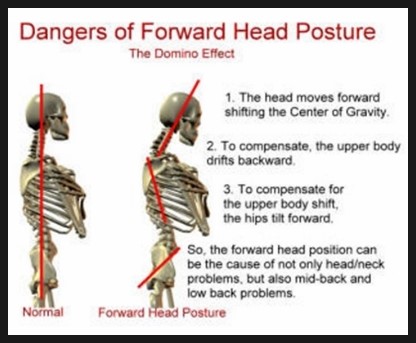 [거북목 증후군] Common Postural Problems & Forward Head Posture / Anterior ...