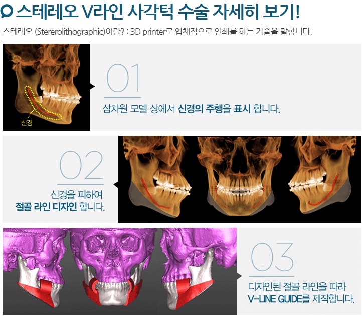 사각턱 전후 외모변화와 효과 : 네이버 블로그
