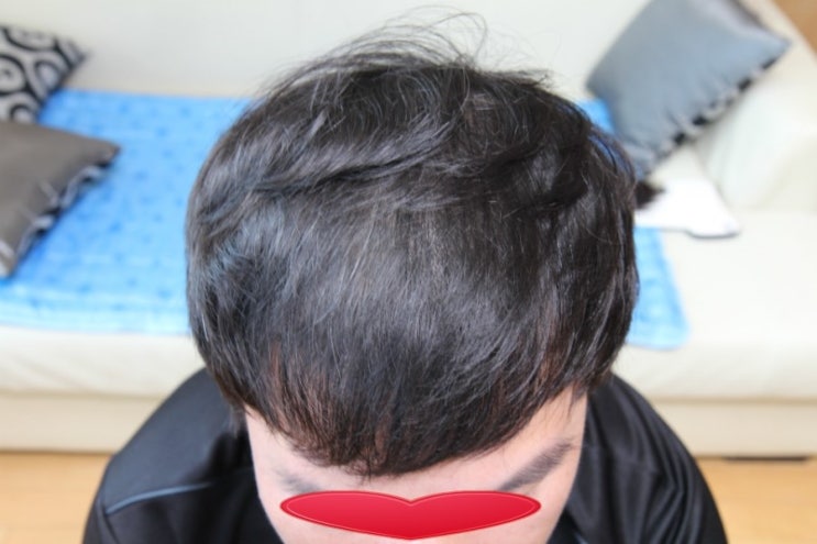 M자 탈모헤어스타일 숱없는 남자머리 머리숱증모 시술전문샵 노원점 다비치레이디앤가이 : 네이버 블로그