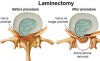 Laminectomy (pf.양) : 네이버 블로그